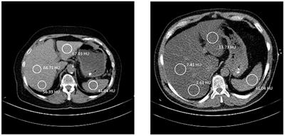 Test–Retest Reliability of the Assessment of Fatty Liver Disease Using Low-Dose Computed Tomography in Cardiac Patients